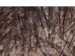 Pele com dermatite seborreica 