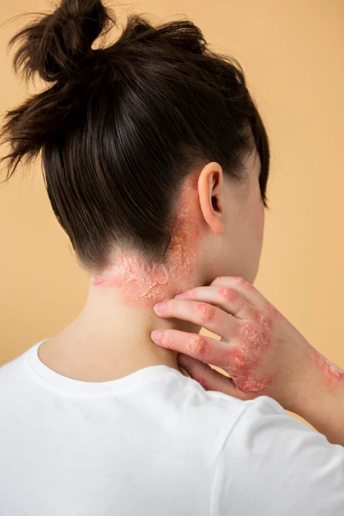 Dermatite de contato por uso de cosméticos inadequados