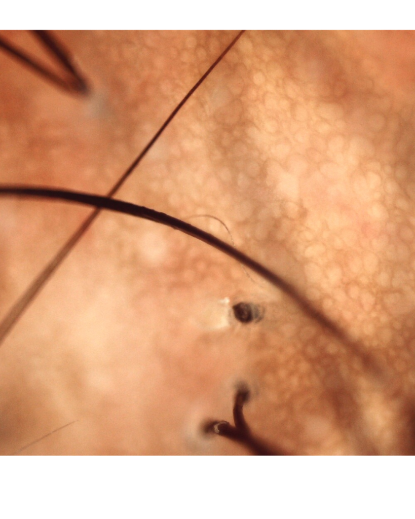 Tricoscopia em cabelo crespo/cacheado área com alopecia por tração: fio quebrado a nível epidérmico