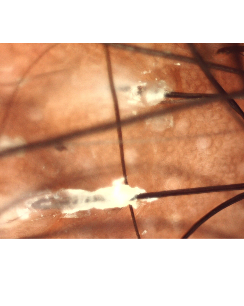 Tricoscopia de cabelo cacheado em área de alopecia por tração: cilindros capilares e início de processo de fibrose