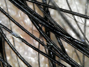 Tricoscopia de cabelo cacheado pós botox capilar: ouro cabeludo com seborreia e eritema (vermelhidão). Fios oleosos. 