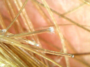 Tricoscopia de cabelo cacheado com botox e descoloração estrutura apresenta tricoptilose (pontas duplas) e tricorrexe nodosa (pontos de quebra) 