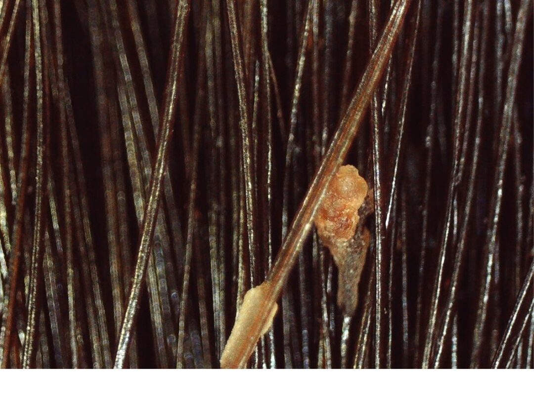 Tricoscopia de piedra branca em cabelos cacheados 