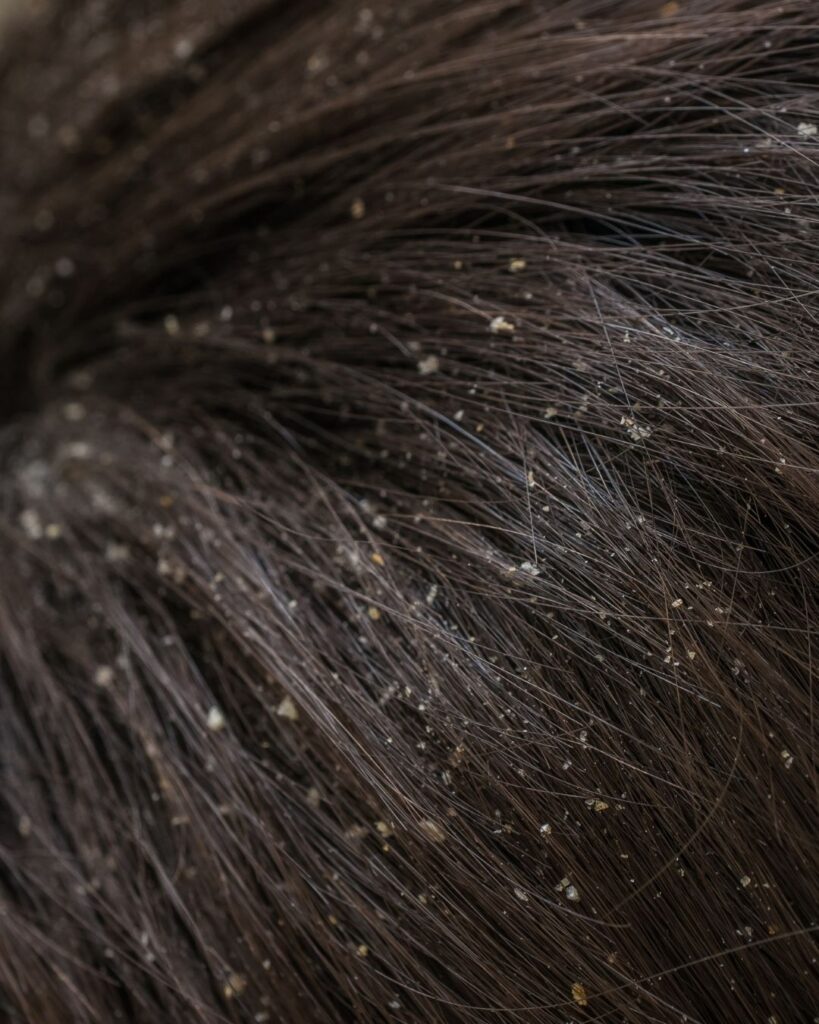 Diferença de piedra branca, caspa e lêndeas 