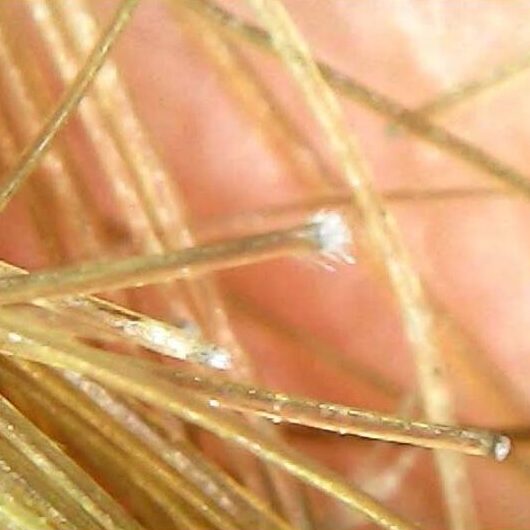 Tricoscopia tricoptilose 