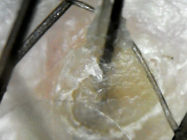 Tricoscopia couro cabeludo com dermatite seborreica