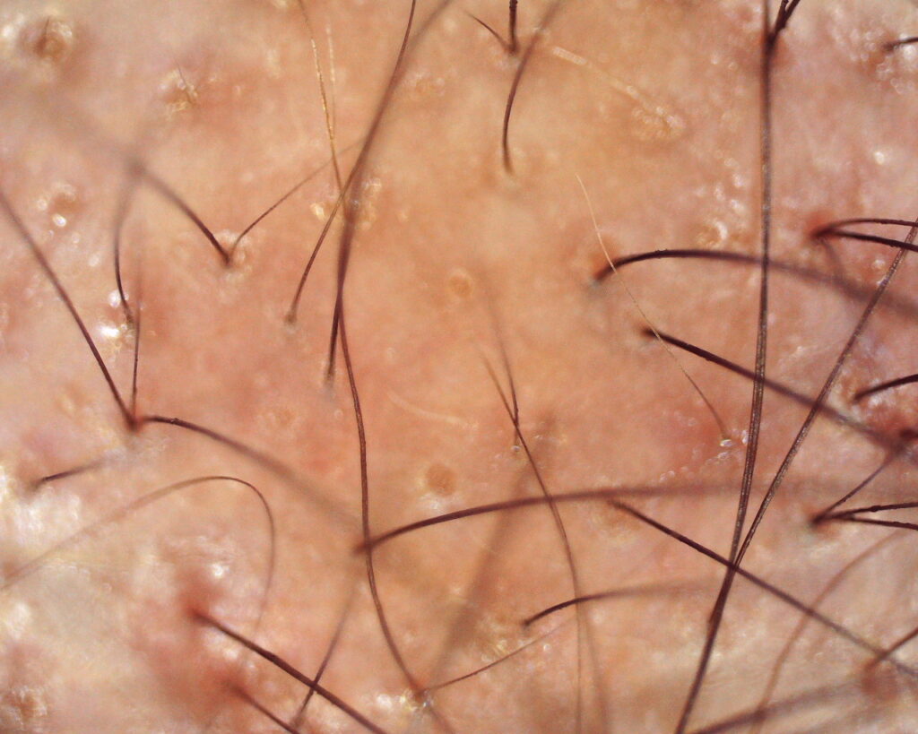 Tricoscopia de alopecia androgenética padrão feminino mostrando afinamento, grande variabilidade de diâmetro e múltiplos óstios quenógenos