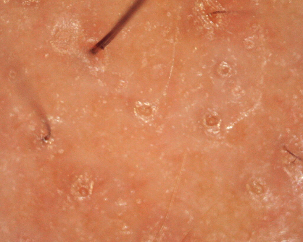 Tricoscopia em alopecia androgenética padrão feminino. Aberturas vazias (óstios quenógenos) na alopecia androgenética. Pêlos em miniaturização folicular.