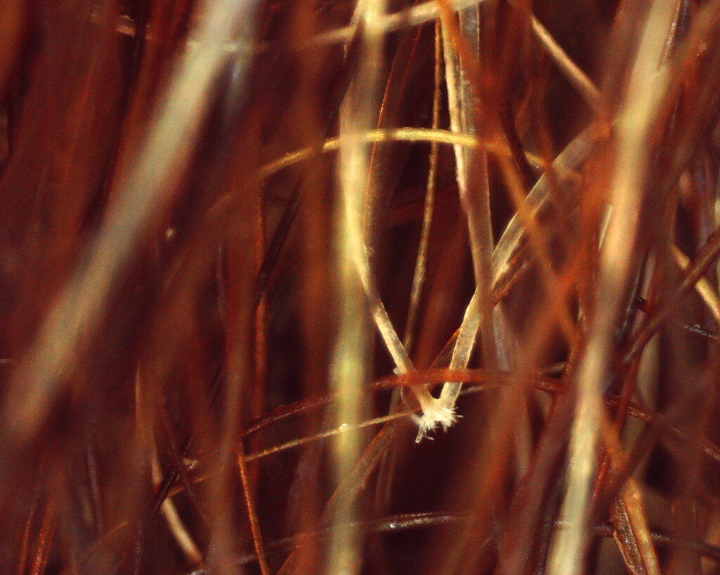 Tricoscopia de cabelo cacheado com quebra  tricorrexe nodosa 