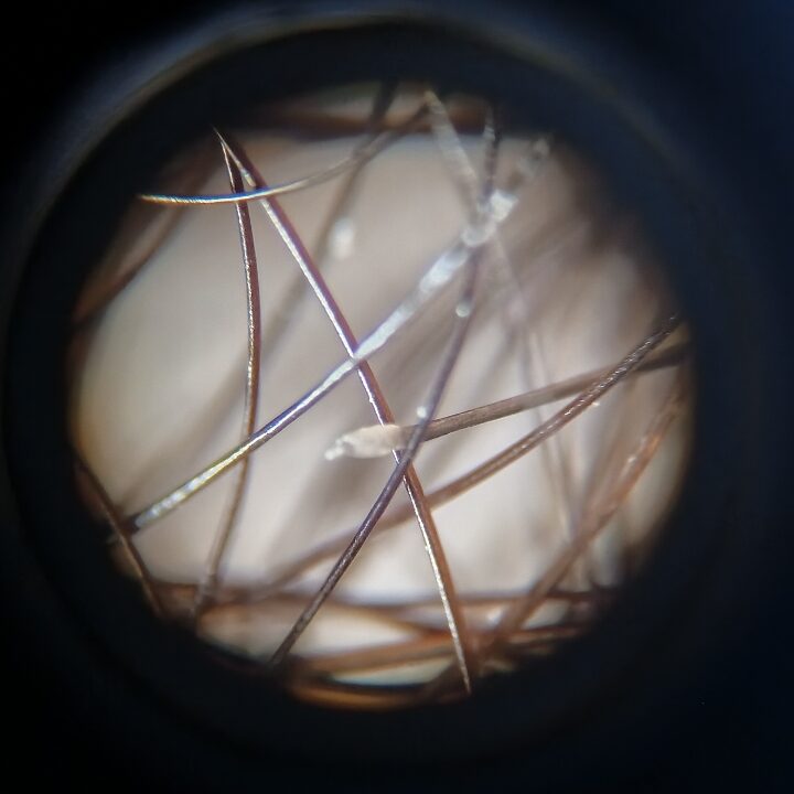 Imagem de microscópio do bulbo capilar cabelo queda acentuada eflúvio telógeno 