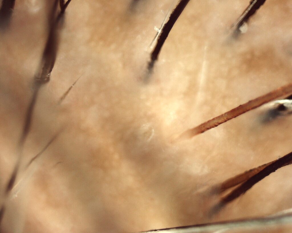 Tricoscopia em cabelo cacheado com eflúvio telógeno: múltiplas unidades foliculares simples, óstio quenógeno e pêlos em recrescimento