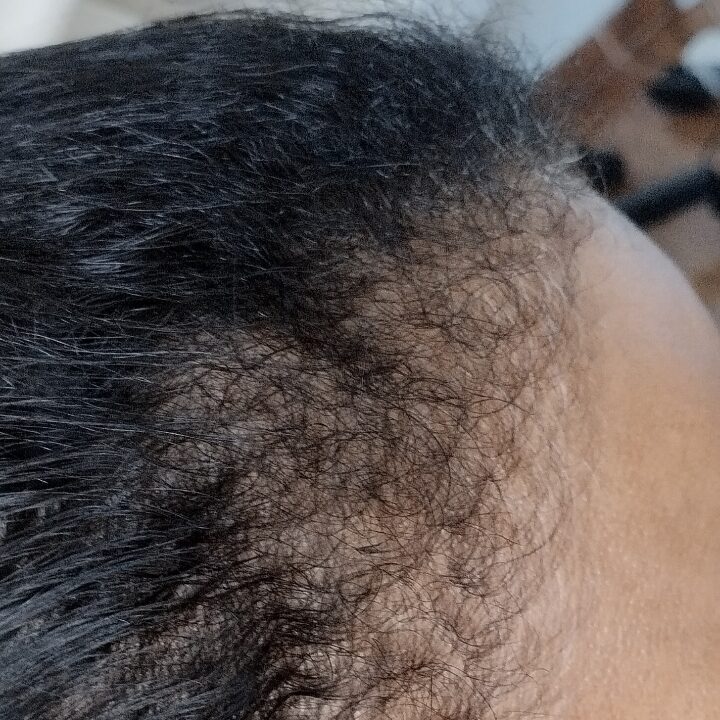 Queda capilar acentuada eflúvio telógeno 