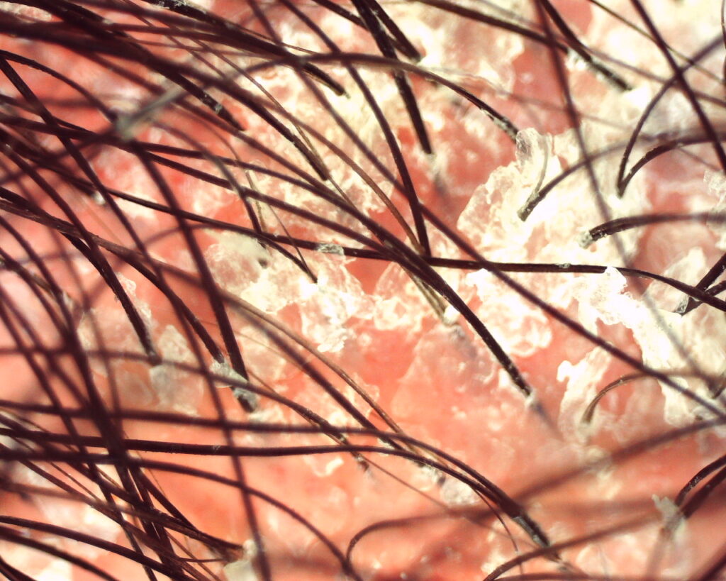 Tricoscopia em psoríase: pele eritematosa, placas descamativas