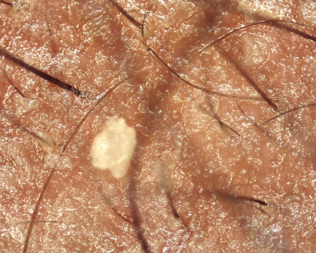 Tricoscopia em Alopecia androgenética em região com excesso de oleosidade (seborréia)