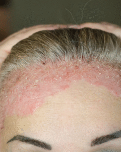 Psoriase no couro cabeludo 