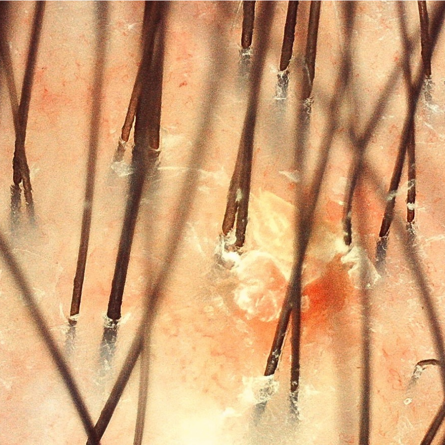 Tricoscopia de lesão de psoríase no couro cabeludo 