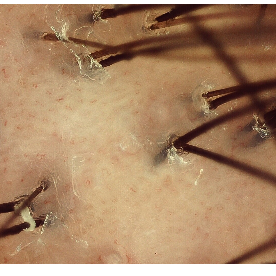 Tricoscopia na psoríase.  Pontos vermelhos. 