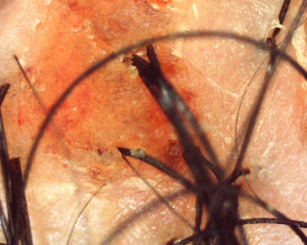 Couro cabeludo dolorido: pequena lesão numa dermatite seborreica 